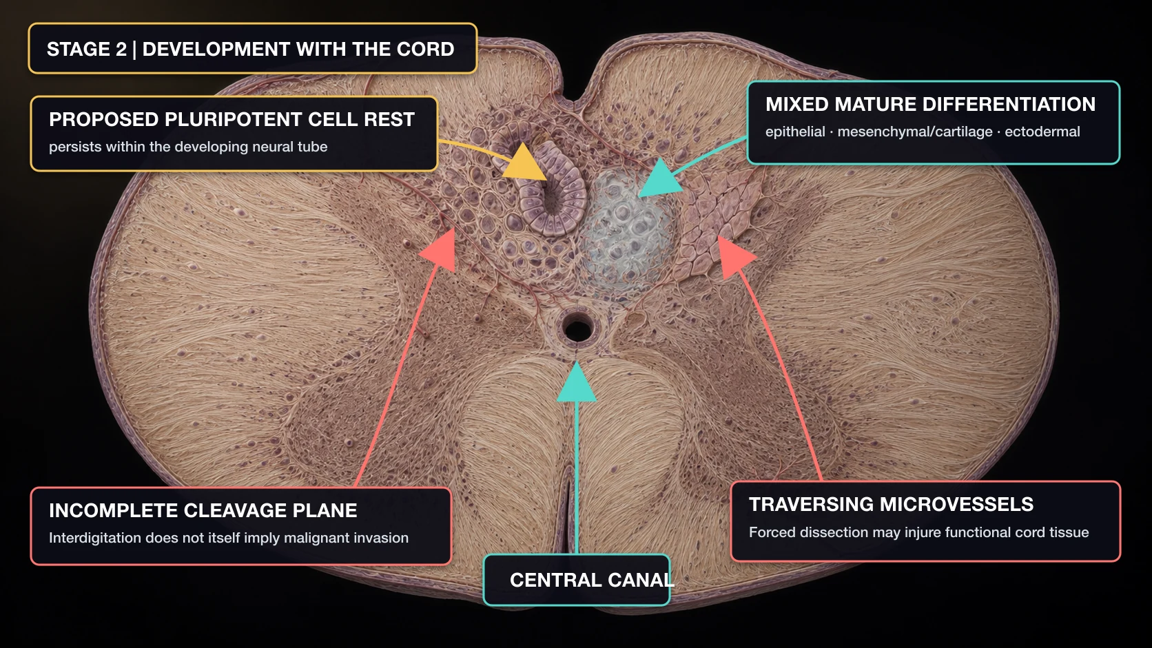 English-annotated AI-assisted spinal cord cross-section showing a proposed pluripotent cell rest, mixed mature tissue differentiation, an incomplete cleavage plane, and traversing microvessels