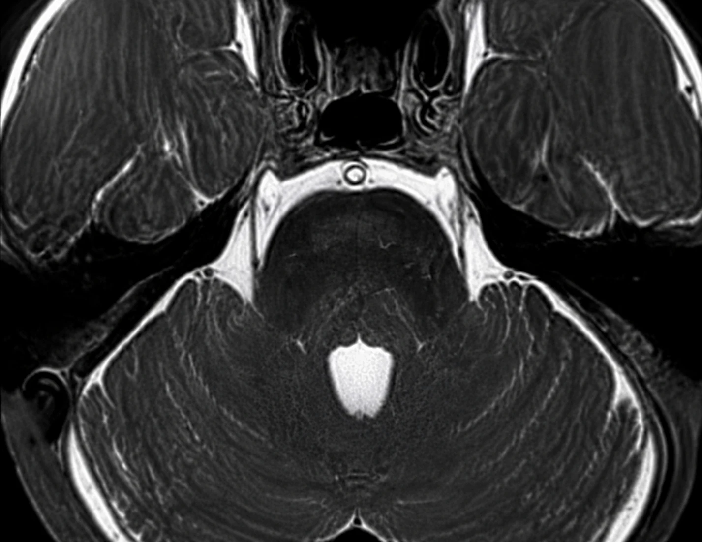 Synthetic axial heavily T2-weighted MRI-style image of the posterior fossa used to teach inspection of the trigeminal cisternal segment